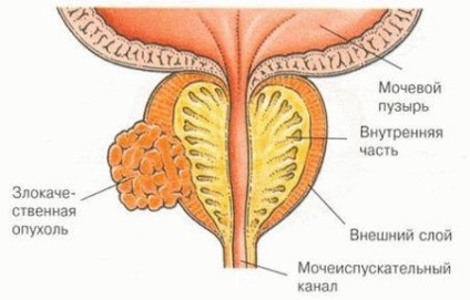 midocalm tratamentul prostatitei