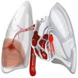 Tüdő- szívbetegség - mi ez, kialakulásának mechanizmusa, a pulmonális artéria (a fejlesztés) Tüdő- szívbetegség - mi ez, kialakulásának mechanizmusa, a pulmonális artéria
