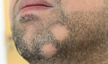 Kopasz folt az állán férfiaknál okoz hajhullás