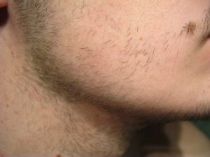 Kopasz folt az állán férfiaknál okoz hajhullás