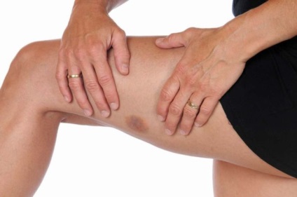 Burst vérerek a lábakban - Okok és kezelés