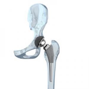 Anyagok csípőprotézis műtét - implantátumok - gyógyászati ​​központ