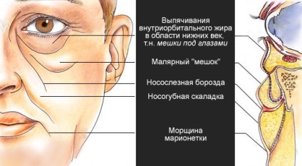 Táskák az arcon -, hogyan lehet megszabadulni