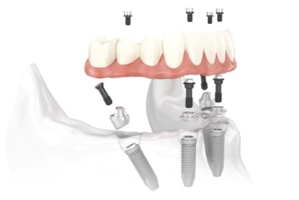 Módszerek Az implantációs (fogak) fogászati implantátumok módszerei