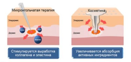 Mezoroller test, különösen a kiválasztása és alkalmazása, ellenjavallatok, és vélemények