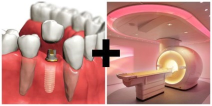 Tehetek egy MRI fogászati implantátumok (csinálni) Tehetek egy MRI fogászati implantátumok