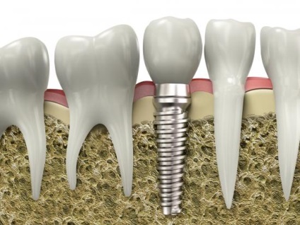 Tehetek egy MRI fogászati implantátumok (lehetséges) Tehetek egy MRI fogászati implantátumok