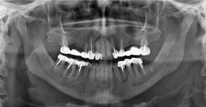 Tehetek egy MRI titán implantátumok fogak