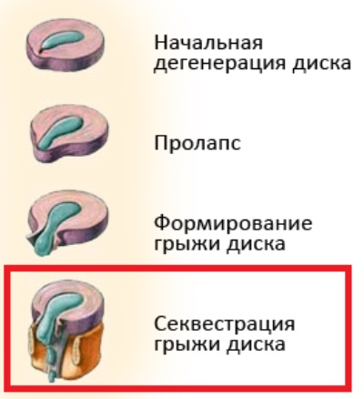 Van gyógymód álcázott gerinc sérv (hernia) Lehetséges, hogy gyógyítani az álcázott sérv a gerinc