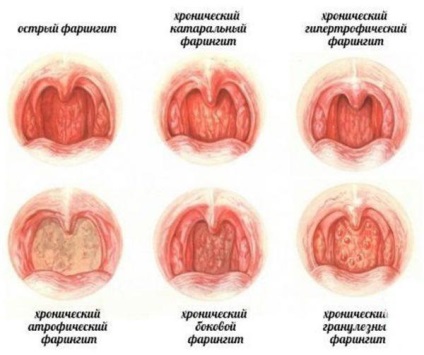 Nasopharyngitis gyermekeknél tünetek és a kezelés az akut és krónikus