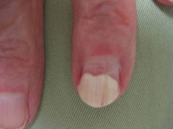 Nails, Part II disztrófiás változások (szegek) Nails, Part II disztróf változások
