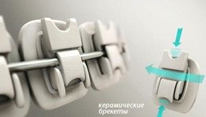 Fogszabályozás, fogszabályozó (kérdéseiben fogszabályozó) Fogszabályozás, fogszabályozás