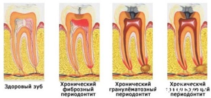 Jellemzői krónikus periodontitis az akut stádiumban