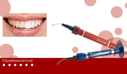 Fogfehérítés opaleszcenciájával boost (opaleszcenciát) Fogfehérítés opaleszcenciát boost