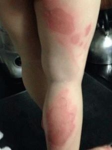 Burn láb forró vízzel, hogy mit és hogyan kell kezelni