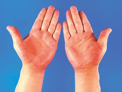 Palmaris erythema (a máj csillag) a test az oka, hogy ez