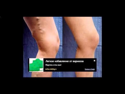 Palmaris erythema (a máj csillag) a test az oka, hogy ez (a test) Palmaris erythema (a máj csillag) a test az oka, hogy ez