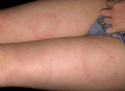 Palmaris erythema (a máj csillag) a test az oka, hogy ez (a test) Palmaris erythema (a máj csillag) a test az oka, hogy ez