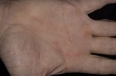 Palmaris erythema (a máj csillag) a test az oka, hogy ez (az ok) Palmaris erythema (a máj csillag) a test az oka, hogy ez