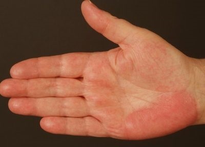 Palmaris erythema (a máj csillag) a test az oka, hogy ez