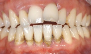 A periodontitis kezelést otthon - a leghatékonyabb népi jogorvoslati
