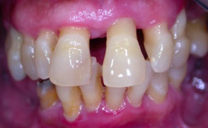A periodontitis kezelést otthon - a leghatékonyabb népi jogorvoslati
