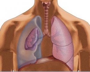 Pneumothorax, tünetei és kezelése okainak pneumothorax (tünetek) Pneumothorax, tünetei és kezelése okainak pneumothorax