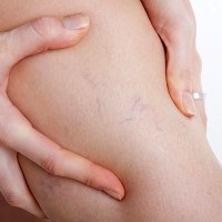 Miért fáj a vénák a kéz, láb, mit kell csinálni (fáj) Miért fáj a vénákban a kéz, láb, mit kell tenni