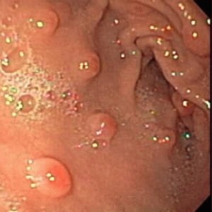 Paradicsom gyomorhurut lehetséges, hogy befolyásolja a gyomor-bél traktus (gastritis) Paradicsom gyomorhurut lehetőség van, hatással vannak a gyomor-bélrendszer