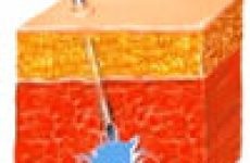 Posztinjekciós infiltráció (infiltráció népi kezelés) befecskendezés beszűrődés