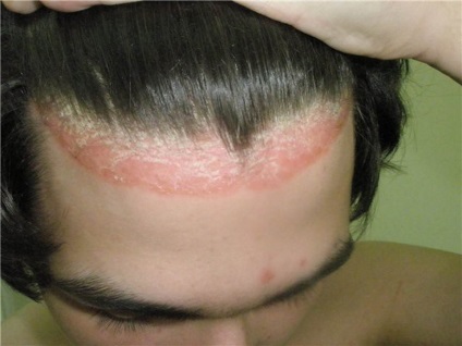 Psoriasis, seborrhoeás - kezelésére seborrhoeás dermatitis