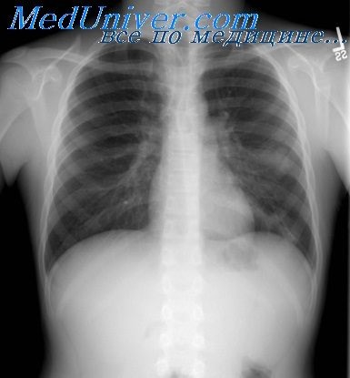 Távolság a hangsúly röntgencső (X-ray tube fókusz) Távolság a hangsúly röntgencsővel