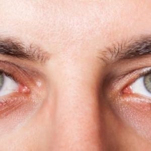 Irritálhatja a szemet, mit kell tennie, mint gyógyítani, segítséget bőrpír a szemét a számítógép
