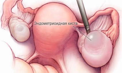 Törés petefészekcisztája tünetek, okok, hatások (petefészek) Törés petefészekcisztája tünetek, okok, hatások