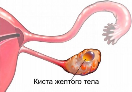 Törés petefészekcisztája tünetek, okok, hatások