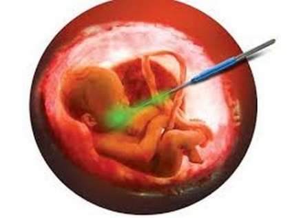 A csökkentés embriók többes terhességek (videó)