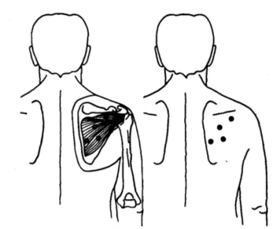 Self-masszázs infraspinatus izmok megszabadulni a fájdalomtól, a vállak és karok