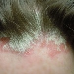 Sebo-psoriasis fotó kezelés (kezelés) Seborrheic psoriasis kép, a kezelés