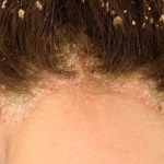 Seborrheic fotó pszoriázis, kezelésére (seborrheás) Seborrheic psoriasis kép, a kezelés