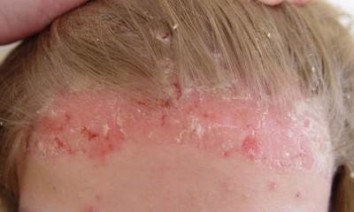 Eucerin®: A bőrről|Seborrheás dermatitisz