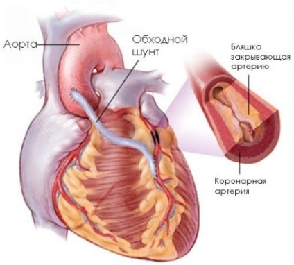 Szív bypass műtét, hogy koszorúér bypass átültetés