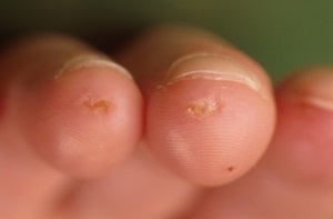 Foltos szklerózis tünetek, okok, kezelés (scleroderma) Foltos szklerózis tünetek, okok, kezelés