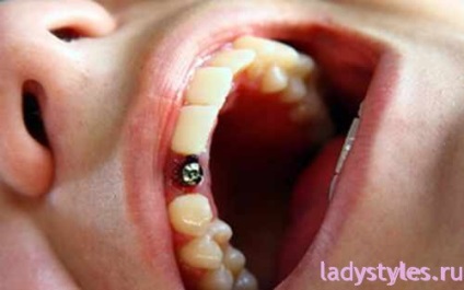 Mennyibe kerül a beültetés egyetlen fog fogászati implantátumok (implantátumok) Mennyibe kerül a beültetés egyetlen fog implantátum