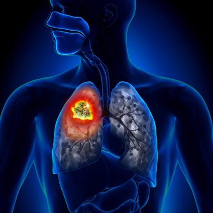 Hány élő tüdőrákos különböző szakaszaiban