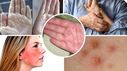 Száraz dermatitis - okai, tünetei és kezelése (fotó)