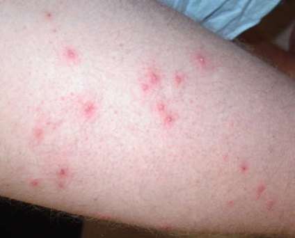 Száraz dermatitis okai és módszerek kezelésére