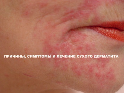 Száraz dermatitis okai és módszerek kezelésére
