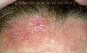 Piros és hámló bőr az arcon: ez a seborrhoeás dermatitis