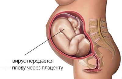 Fertőző átviteli útvonal vektorok patológiák (átviteli) Transzmisszív átviteli mód hordozók patológiák