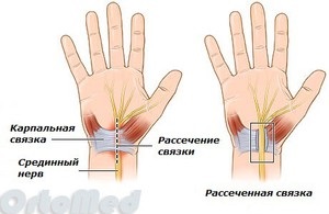 Kéztőalagút szindróma kezelésére, kéztőcsatorna szindróma